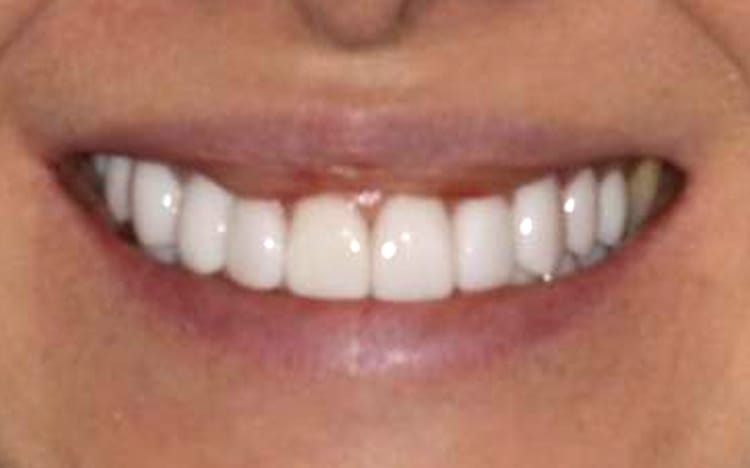 13. Patient AY (9 teeth + 1 implant)_ Mix of porcelain veneers, crowns and implant crown on upper 10 teeth After