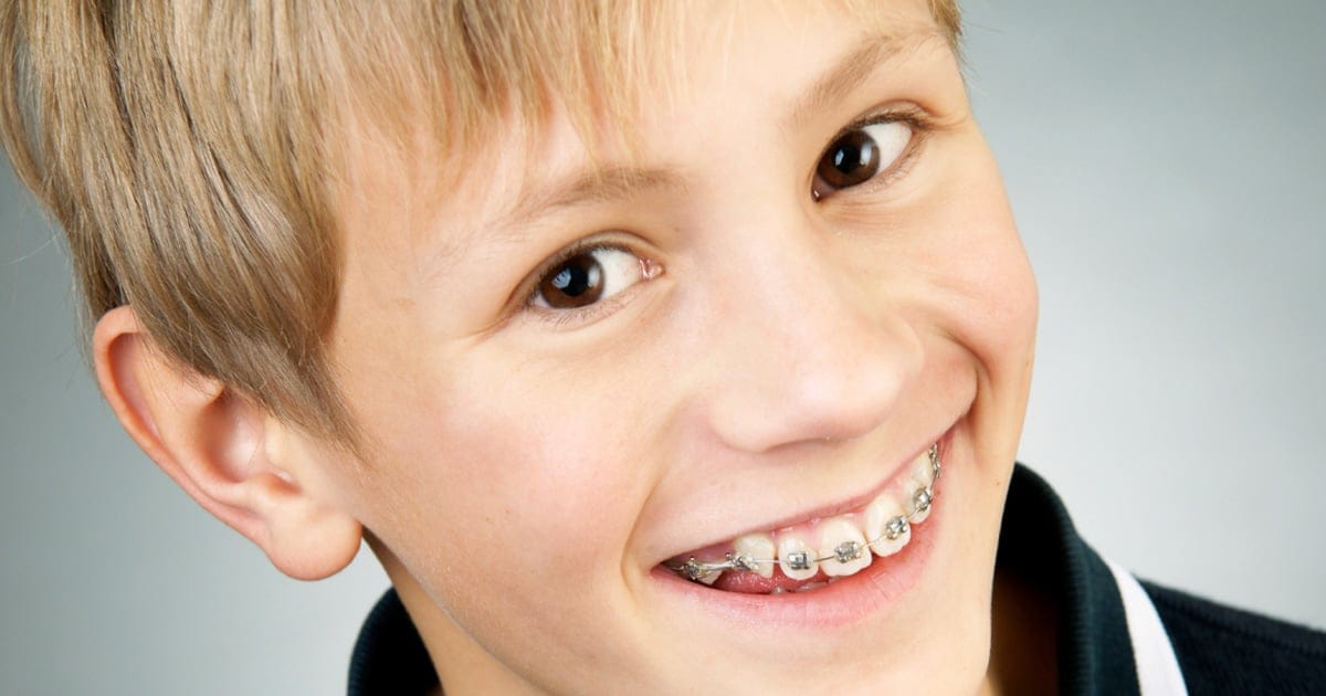 Proper Brushing with Braces