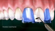 Composite Filling (Anterior) 004