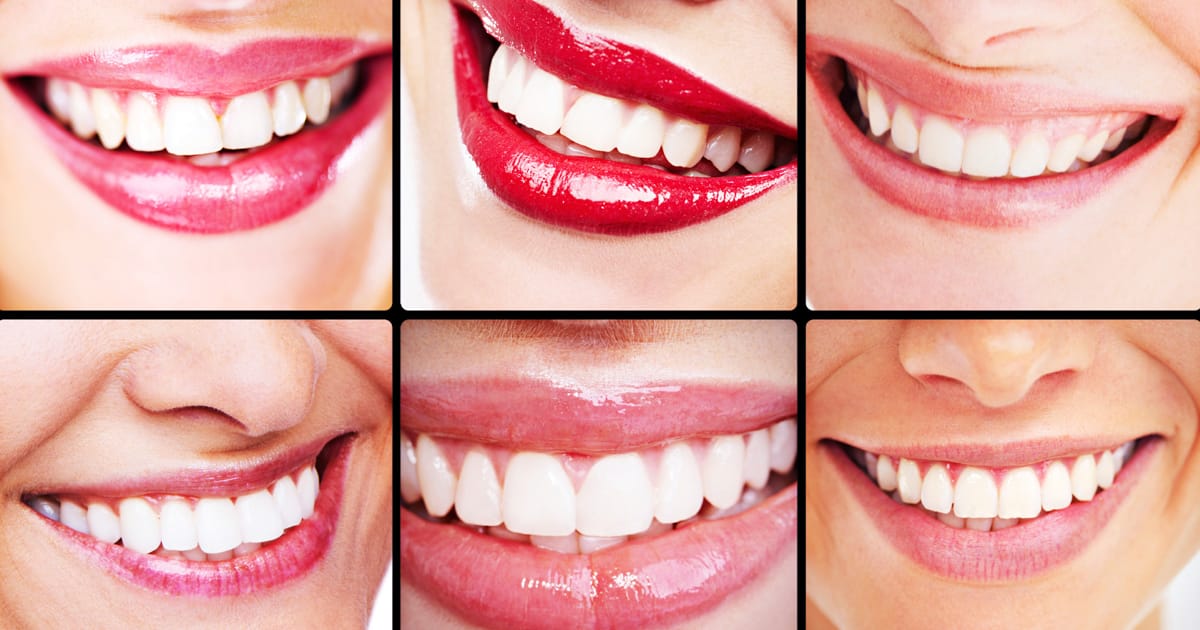 General Dental Advice about Crowns, Veneers, and Lumineers