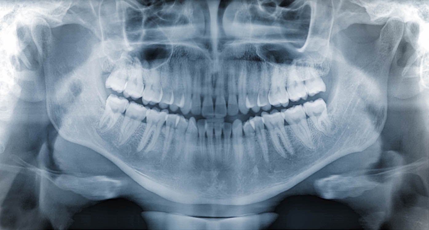 What Causes Crooked Teeth?