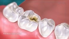 Amalgam Filling (Posterior) 001