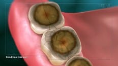 Dental Erosion 004