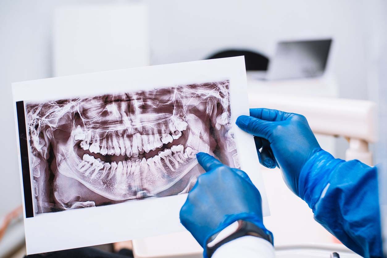 Wisdom Teeth X-Ray