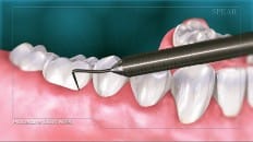 Gingival Probing And Pocket Depth 004