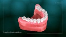 Removable Complete Dentures 005