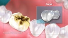 Filling Versus Crown (Impression) 001