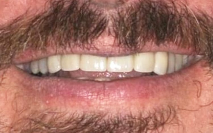 9. Patient SS (6 teeth)_ 6 porcelain crowns on upper front teeth After
