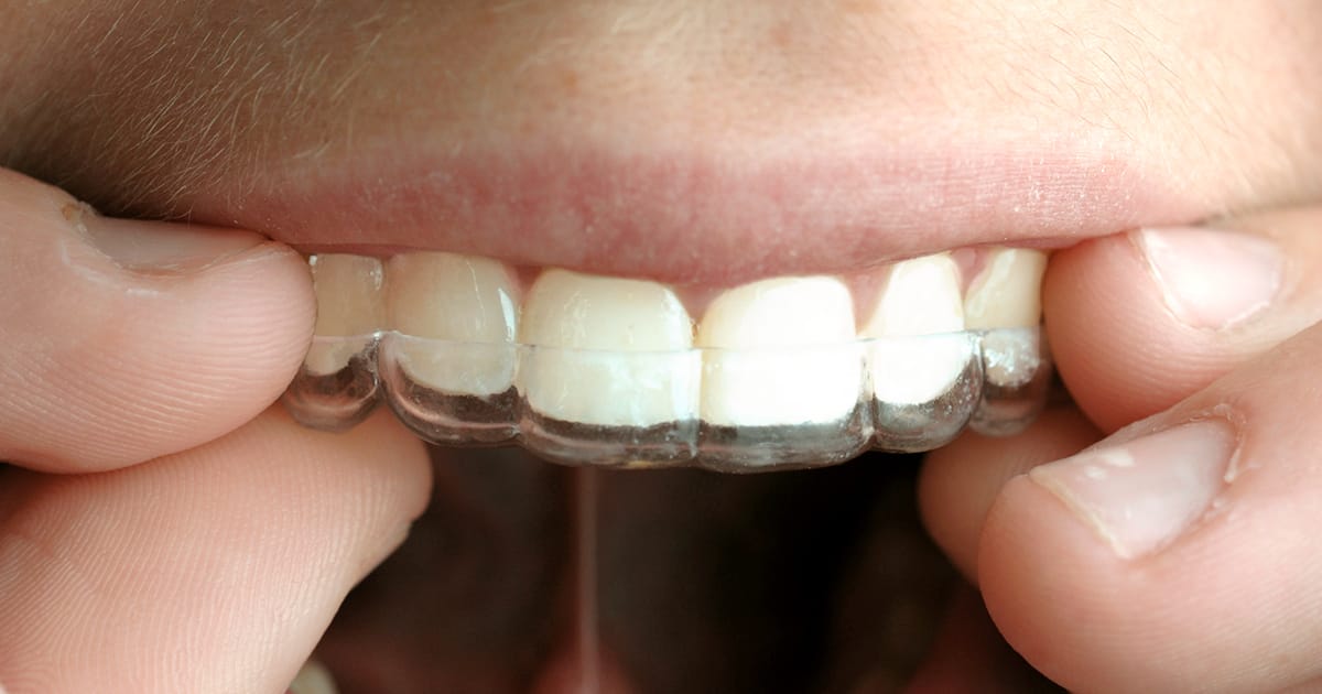 The Wonders of Invisalign® The Wonders of Invisalign®