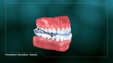 Sleep Appliances - Sleep Apnea 005