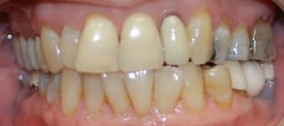 Full mouth reconstruction before Rotter
