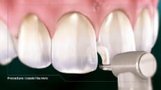Composite Filling (Anterior) 002