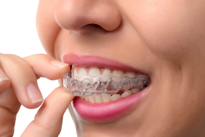 Invisalign Health Benefits
