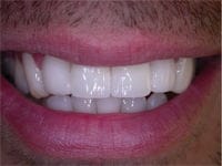 Veneers after