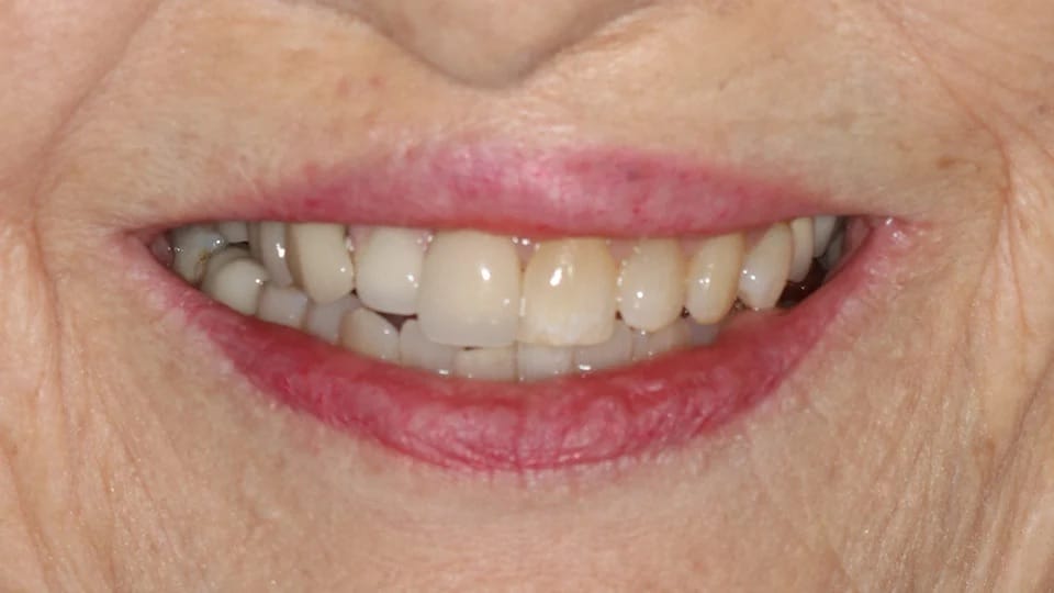 Anastasia Smile 10 before image