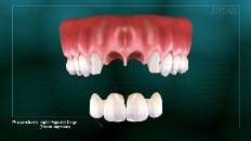 Implant-Supported Bridge 007
