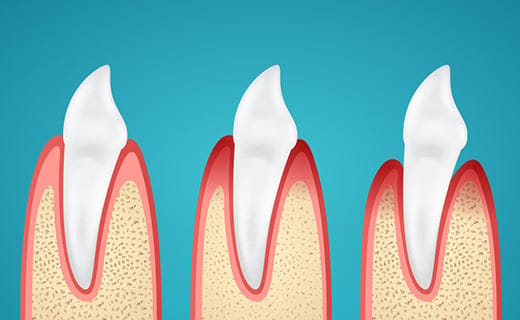 How Can You Prevent Gingivitis and Gum Disease? How Can You Prevent Gingivitis and Gum Disease?