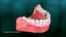 Removable Partial Dentures 005