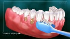 Understanding Tooth Wear 004