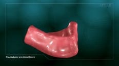 Screw Retained Dentures 001