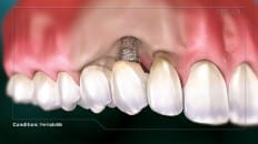 Peri-Implantitis 003