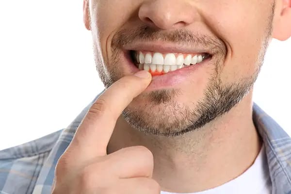 Man pointing to bleeding gums showing early signs of gum disease Man pointing to bleeding gums showing early signs of gum disease