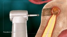 Apicoectomy image 003