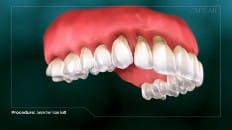 Connective Tissue Graft 001