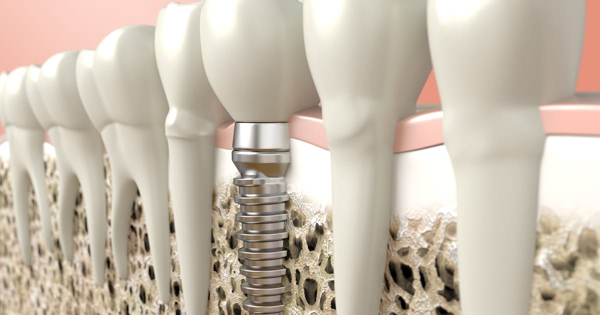 Are You Missing Teeth? Find Your Smile Solution with a Dental Implant Are You Missing Teeth? Find Your Smile Solution with a Dental Implant