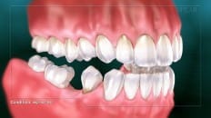 Single Tooth Loss 005
