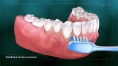 Non-Carious Cervical Lesions 003