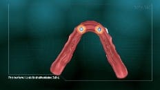 Locator Retained Overdenture (Reline) 003