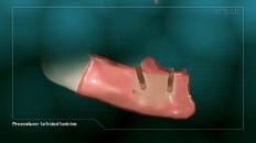 Bar Retained Overdenture 006