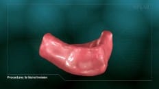 Bar Retained Overdenture 001