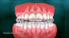 Occlusal Appliance For Tooth Wear 003