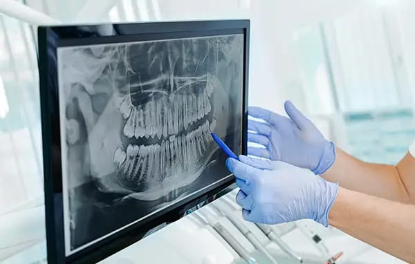 Dentist analyzing dental X-ray to examine existing fillings and restorations
