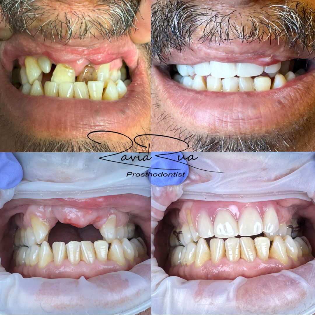 TC Cape Coral Case 22 Top Partial for a patient with cleft lip and palate