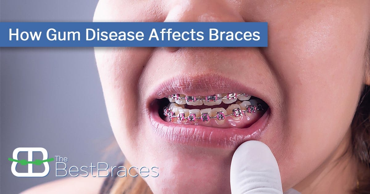 How Gum Disease Affects Braces