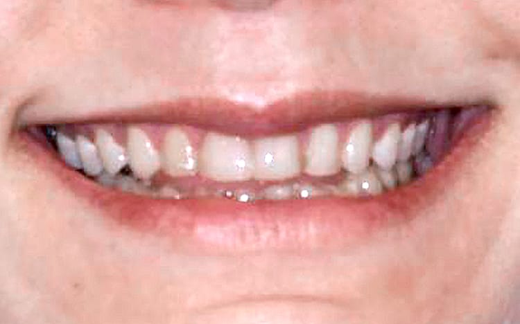 27 (1). Patient MR (all 28 teeth)_ 14 upper porcelain crowns and 14 lower porcelain crowns Before