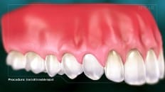 Bone Graft With Immediate Implant Placement 007