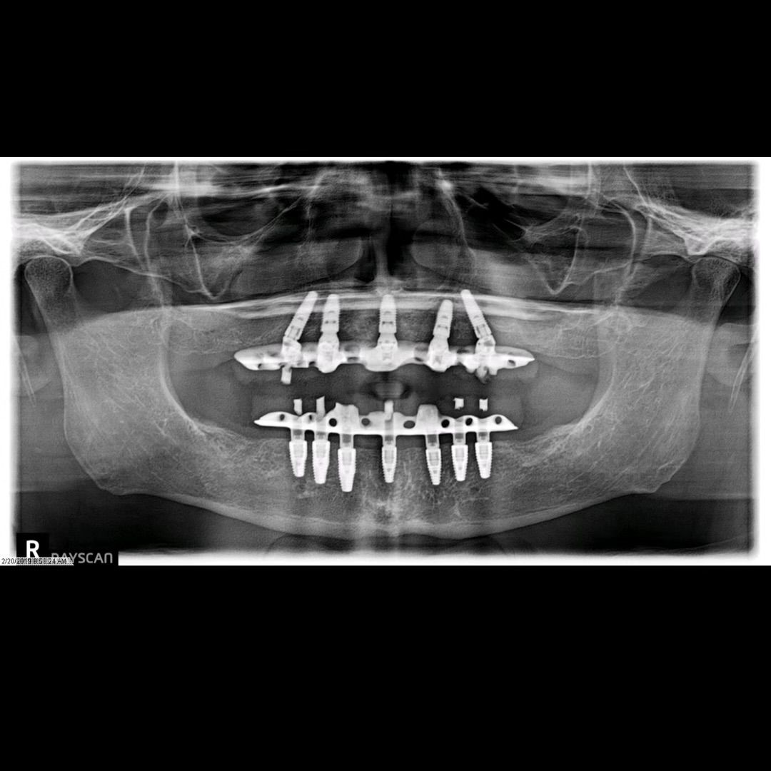 TC Cape Coral Case 5.2 All on 6-7 implant hybrids