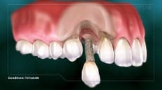 Peri-Implantitis 004