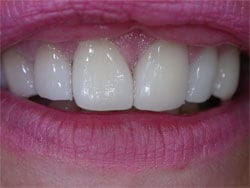 Veneers after