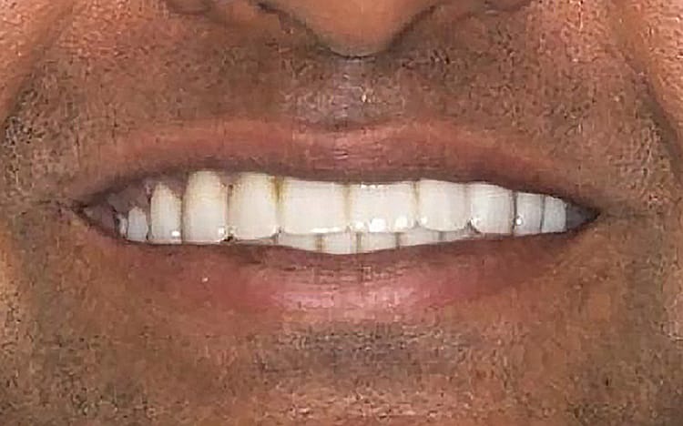 26 (1). Patient VB (all 28 teeth) _ 14 upper porcelain crowns and 14 lower porcelain crowns After