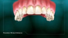 Whitening With Bleaching Tray 004