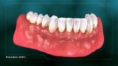 Gingivitis 005