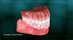 Removable Partial Dentures 007
