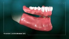 Locator Retained Overdenture (Reline) 007