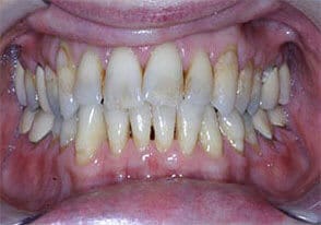 ballston smile gallery case-14-before