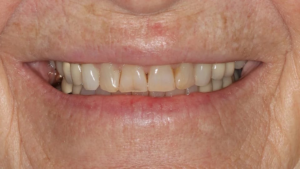 Anastasia Smile 08 before image